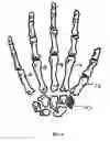 Fig. 07 - TRAPEZIUM PROSTHESIS