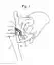 Fig. 02 - Acetabular cup