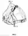 Fig. 03 - Method and device for providing an opening on a head strap on a Baseball or Softball sports protective face mask to permit a person to tie back their hair or wear a ponytail style while properly securing the head strap