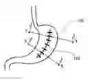 Fig. 01 - Methods and devices for reducing gastric volume