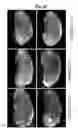 Fig. 07 - Methods of diagnosing, preventing and treating cancer metastasis
