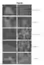 Fig. 14 - Methods of diagnosing, preventing and treating cancer metastasis