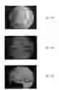 Fig. 05 - Bone graft materials  and methods
