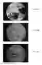 Fig. 08 - Bone graft materials  and methods