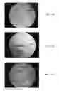Fig. 13 - Bone graft materials  and methods