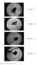 Fig. 16 - Bone graft materials  and methods