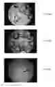 Fig. 17 - Bone graft materials  and methods