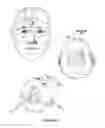 Fig. 09 - Compositions and Methods for Improving Prognosis of a Human with Subarachnoid Hemorrhage