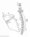 Fig. 06 - Dental wedge with tooth guard and method of restoring a tooth using the same