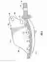 Fig. 07 - Dental wedge with tooth guard and method of restoring a tooth using the same