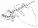 Fig. 01 - Dental fulcrum