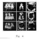 Fig. 05 - Methods for inhibiting peritoneal dissemination of cancer cells