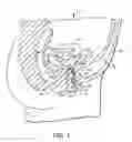 Fig. 02 - Vaginal insert device having a support portion with plurality of foldable areas