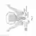 Fig. 02 - Pelvic Tissue Plication System