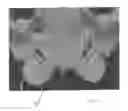 Fig. 06 - Implantable devices for the treatment of incontinence and methods of using same