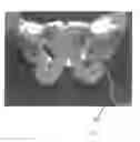 Fig. 09 - Implantable devices for the treatment of incontinence and methods of using same