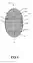 Fig. 04 - RADIOPAQUE IMPLANT