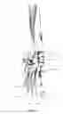 Fig. 11 - Systems and methods for treating acute and/or chronic injuries in soft tissue