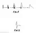 Fig. 03 - Method For Diagnosis And Treatment Of Vessel Occulsion