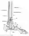 Fig. 01 - Intramedullary locked compression screw for stabilization and union of complex ankle and subtalar deformities