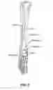 Fig. 03 - Intramedullary locked compression screw for stabilization and union of complex ankle and subtalar deformities