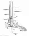 Fig. 07 - Intramedullary locked compression screw for stabilization and union of complex ankle and subtalar deformities