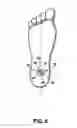 Fig. 08 - Intramedullary locked compression screw for stabilization and union of complex ankle and subtalar deformities