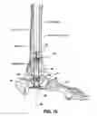 Fig. 10 - Intramedullary locked compression screw for stabilization and union of complex ankle and subtalar deformities