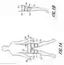 Fig. 02 - Suprapatellar external counterpulsation apparatus