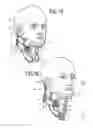 Fig. 07 - Cervical collar with independent height and circumference adjustability