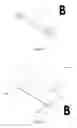 Fig. 12 - INTRAOCULAR SHUNTS