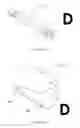 Fig. 13 - INTRAOCULAR SHUNTS