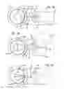 Fig. 16 - Dissection handpiece with aspiration means for reducing the appearance of cellulite