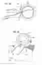 Fig. 17 - Dissection handpiece with aspiration means for reducing the appearance of cellulite