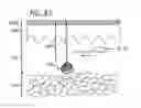 Fig. 41 - Dissection handpiece with aspiration means for reducing the appearance of cellulite