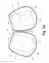 Fig. 03 - DEVICES AND METHODS FOR MAINTAINING AN ASEPTIC CATHETER ENVIRONMENT