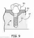Fig. 10 - DRUG ELUTING IMPLANT