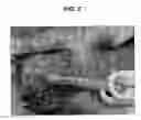 Fig. 03 - Activation of bone and cartilage formation
