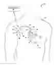 Fig. 01 - Therapeutic agent reservoir delivery system