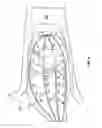 Fig. 05 - Balloon catheter with flexible electrode assemblies