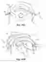 Fig. 27 - Skin suturing device using rotating needles