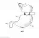 Fig. 02 - METHOD AND DEVICE FOR USE IN ENDOSCOPIC ORGAN PROCEDURES