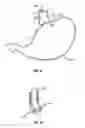 Fig. 05 - METHOD AND DEVICE FOR USE IN ENDOSCOPIC ORGAN PROCEDURES