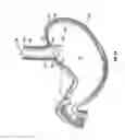 Fig. 06 - METHOD AND DEVICE FOR USE IN ENDOSCOPIC ORGAN PROCEDURES