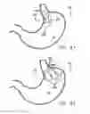 Fig. 53 - Single fold device for tissue fixation