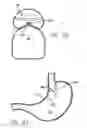 Fig. 57 - Single fold device for tissue fixation