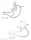 Fig. 58 - Single fold device for tissue fixation