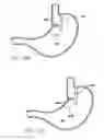 Fig. 59 - Single fold device for tissue fixation