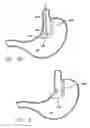 Fig. 61 - Single fold device for tissue fixation