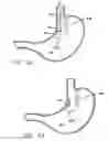 Fig. 62 - Single fold device for tissue fixation